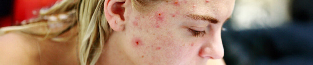 Sie sehen ein Bild einer weiblichen Jugendlichen, die an Akne Vulgäres leidet. Die gewöhnliche Akne (Acne vulgaris) ist eine chronische, entzündliche Hauterkrankung mit Pickeln, Komedonen und Pusteln. Betroffen ist die talgdrüsenreiche Haut im Gesicht und Nacken, oft auch an Brust und Rücken. Die Hauterkrankung bricht typischerweise in der Pubertät aus und klingt danach meist wieder spontan ab.