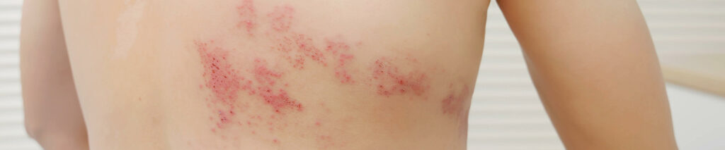 Sie sehen einen Rücken der befallen ist mit Gürtelrose (Herpes zoster, Infektion durch Varicella-Zoster-Virus).