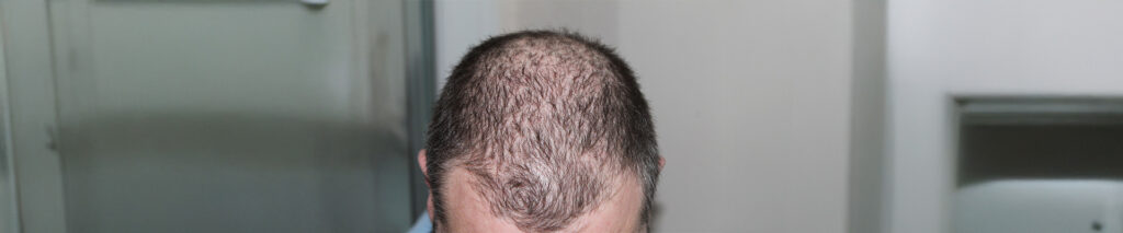 Hier sehen Sie eine männliche Person mit Haarausfall. Hier finden Sie alles über natürliche Hausmittel gegen Haarausfall. Weil der Übergang von natürlichem Haarausfall zu krankhaftem Haarausfall schwer zu definieren ist, hat man als kritische Grenze den Verlust von 100 Haaren pro Tag festgelegt. Daneben gibt es einen altersbedingten und in gewisser Weise normalen Haarausfall. Beim Säugling findet er direkt nach der Geburt statt, bei Männern im dritten und vierten Lebensjahrzehnt, und bei Frauen – allerdings diffus und weniger ausgeprägt – manchmal ab dem dritten, meist aber erst nach dem 5. Lebensjahrzehnt. Normal ist auch ein Haarausfall zwei bis zwölf Wochen nach einer Entbindung.