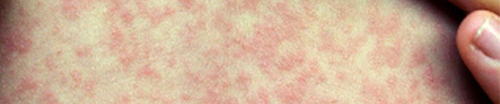 Hier sehen Sie ein Kind mit Masern. Masern werden durch ein ausschließlich beim Menschen vorkommendes RNA-Virus ausgelöst. Die Krankheit überträgt sich durch direkten Kontakt mit Infizierten oder mittels Tröpfcheninfektion. Masernviren sind gegenüber Licht, Luft, Hitze und Desinfektionsmittel sehr empfindlich, so dass sie außerhalb des menschlichen Körpers nach etwa zwei Stunden absterben. Die Krankheit wird praktisch kaum über gemeinsam benutzte Gegenstände übertragen. 