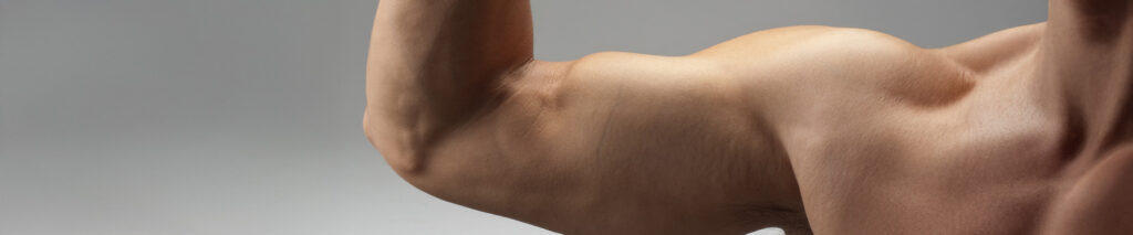 Sie sehen ein Kraftsportler der durch Übertraining, Falschbelastung einen Tennisarm bekommen hat. Tennisarm (Tennisellenbogen, Epicondylitis humeri radialis, Mausarm) ist eine der häufigsten Erkrankungen des Ellenbogengelenks und betrifft nicht nur Tennisspieler, sondern auch viele andere Menschen – insbesondere jene, die repetitive Bewegungen oder Fehlbelastungen im Alltag oder Beruf ausführen. Interessanterweise kann diese schmerzhafte Sehnenentzündung am Ellenbogen auch bei Personen auftreten, die ihren Ellenbogen keiner übermäßigen Belastungaussetzen.