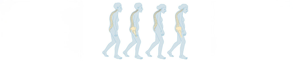 Sie sehen ein Sympolbild für den Bereich Osteoporose.